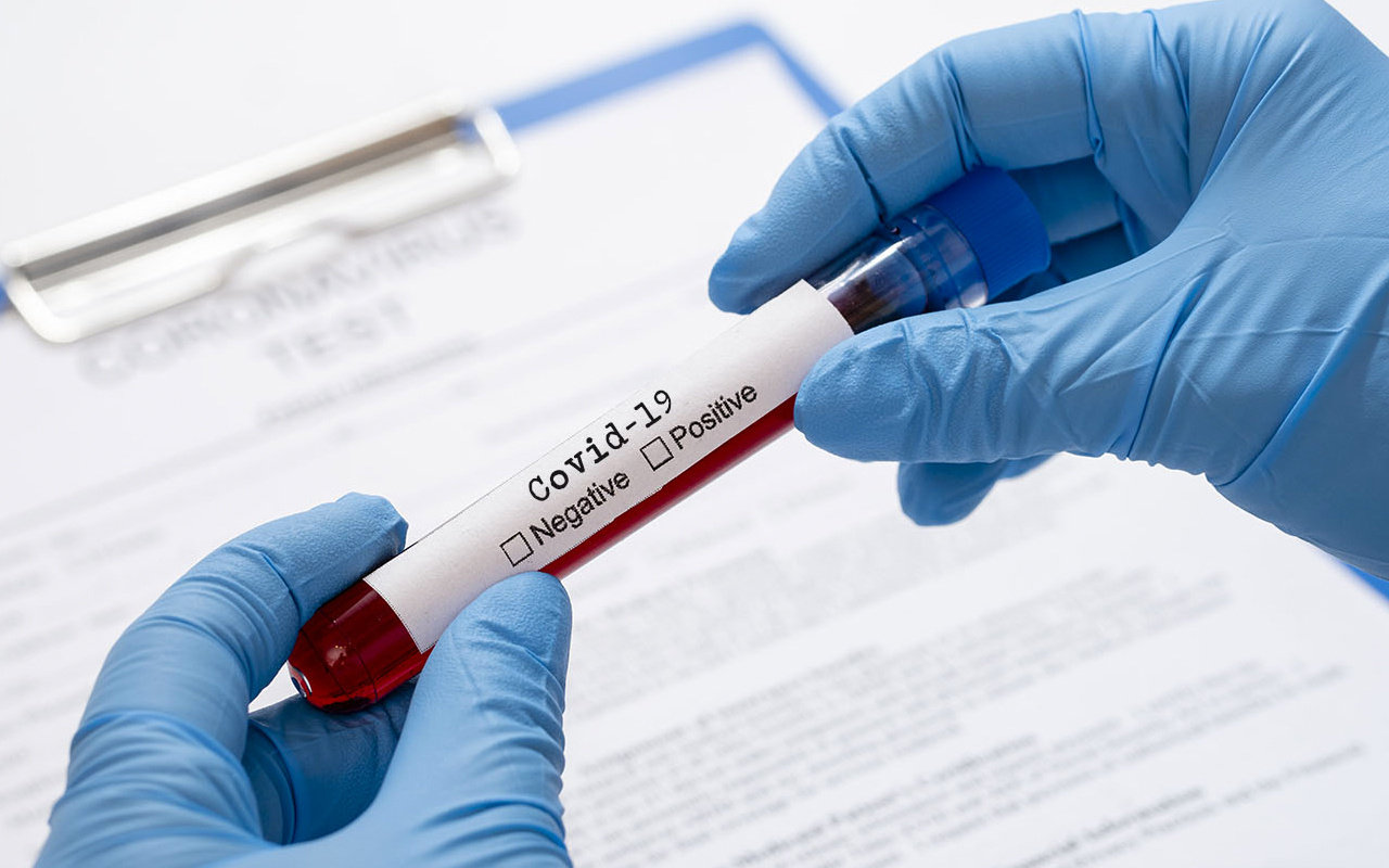 CORONAVİRÜS NERELERDE YAŞAR 2 covid 19 testi koronavirus turkiy SBaL a9aea